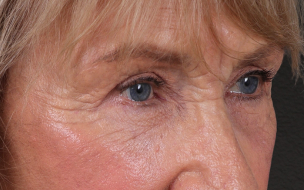 Blepharoplasty Before & After Gallery - Patient 162903 - Image 2