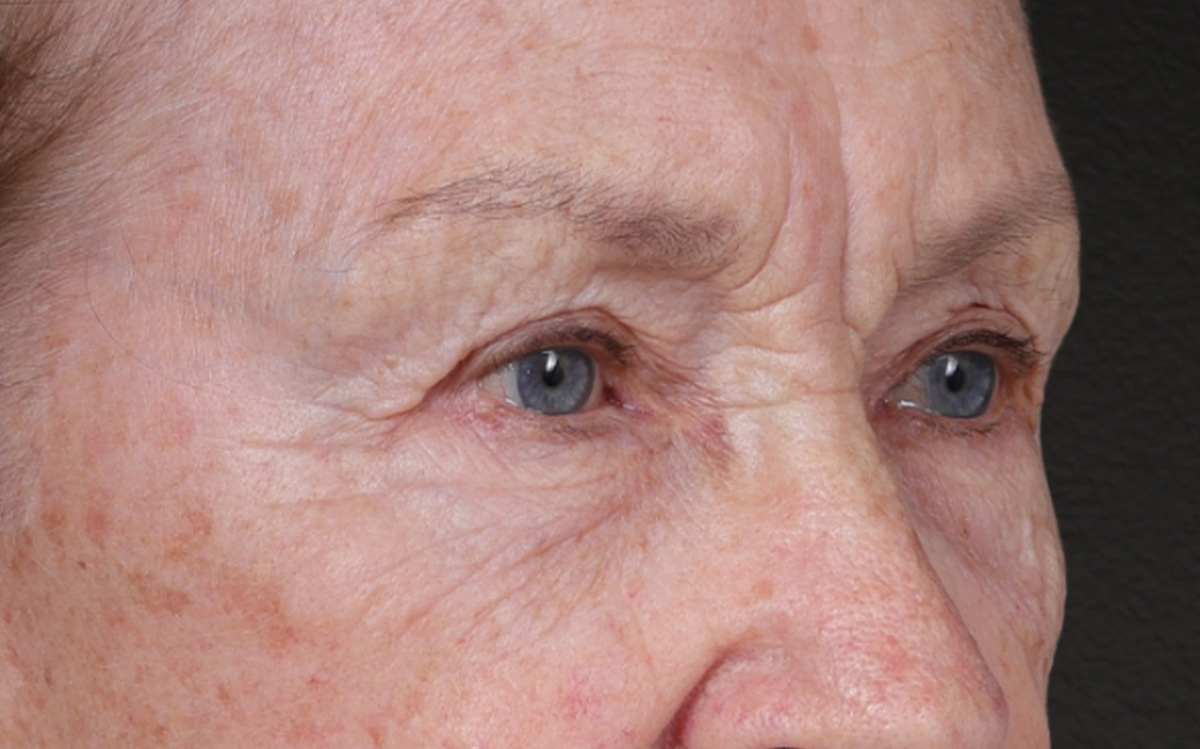 Blepharoplasty Before & After Gallery - Patient 162903 - Image 1