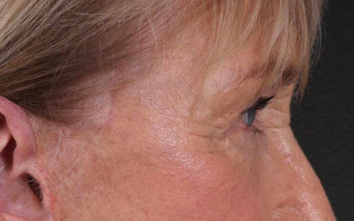 Blepharoplasty Before & After Gallery - Patient 162903 - Image 6