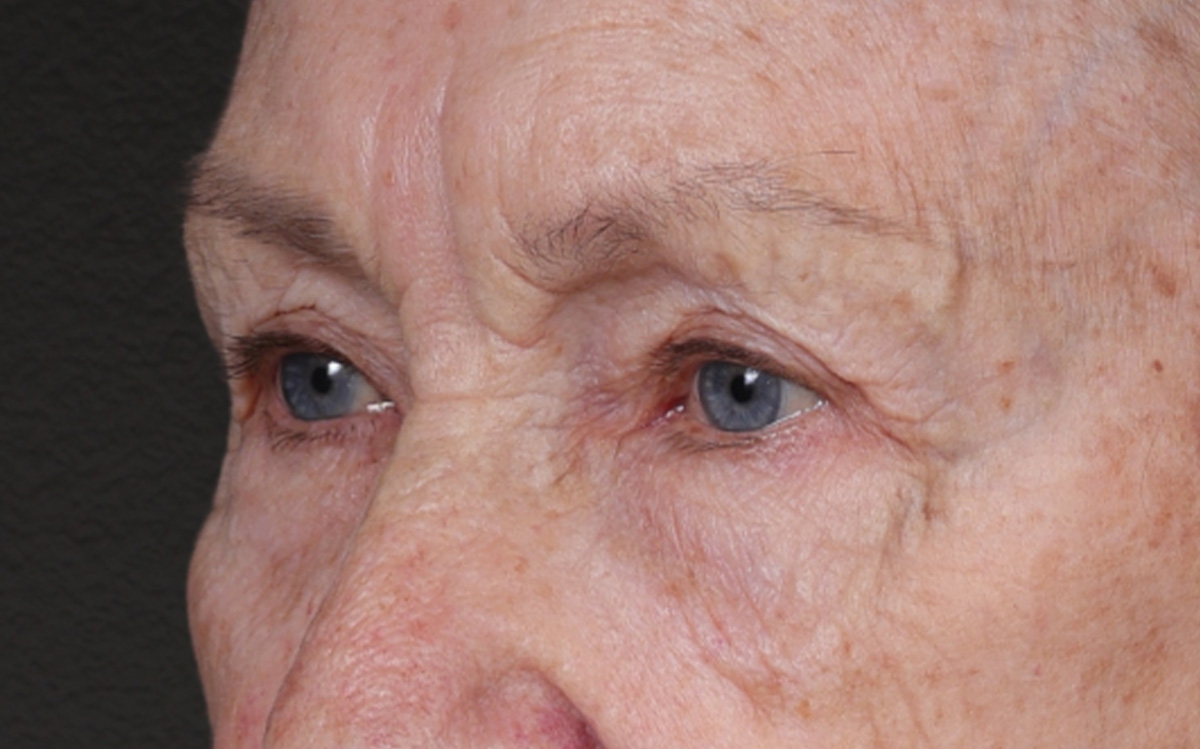 Blepharoplasty Before & After Gallery - Patient 162903 - Image 7