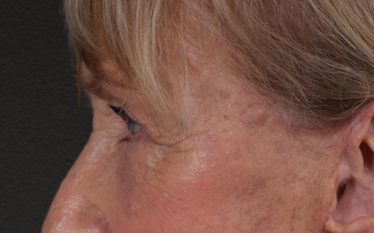 Blepharoplasty Before & After Gallery - Patient 162903 - Image 10