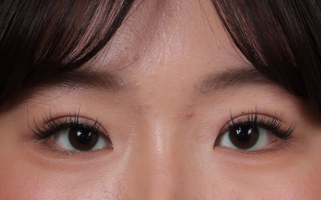 Blepharoplasty Before & After Gallery - Patient 308998 - Image 2