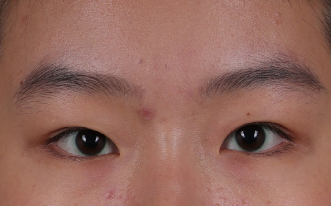 Blepharoplasty Before & After Gallery - Patient 308998 - Image 1