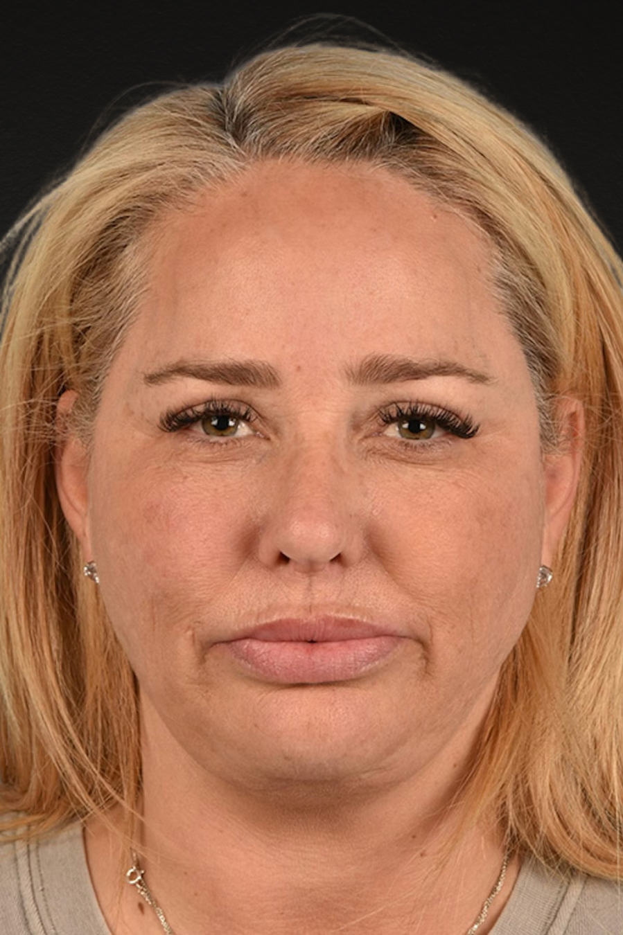 Renuvion Before & After Gallery - Patient 364740 - Image 2