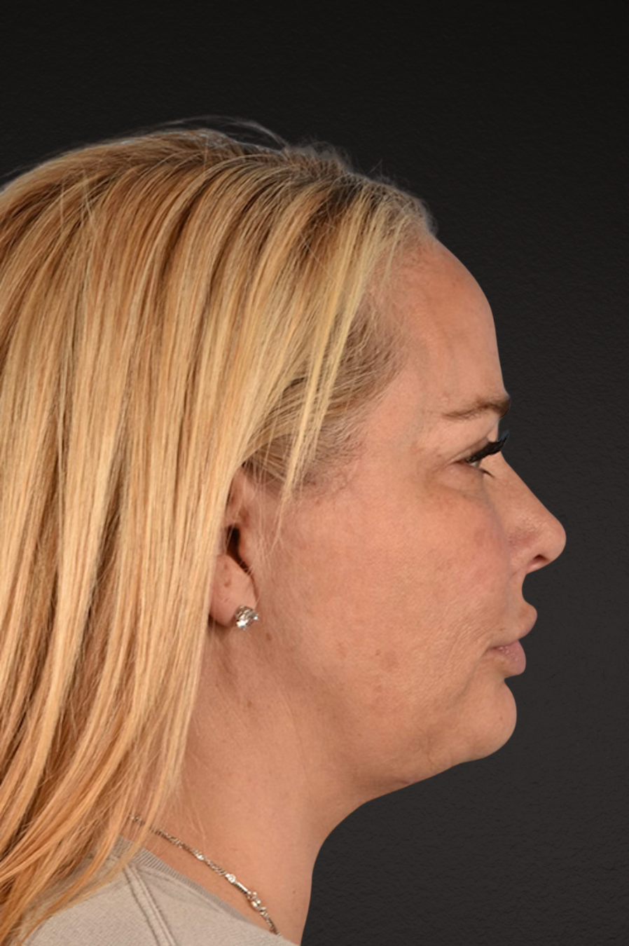 Renuvion Before & After Gallery - Patient 364740 - Image 8