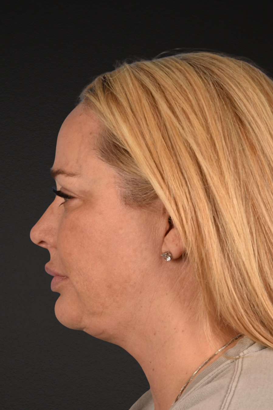 Renuvion Before & After Gallery - Patient 364740 - Image 6