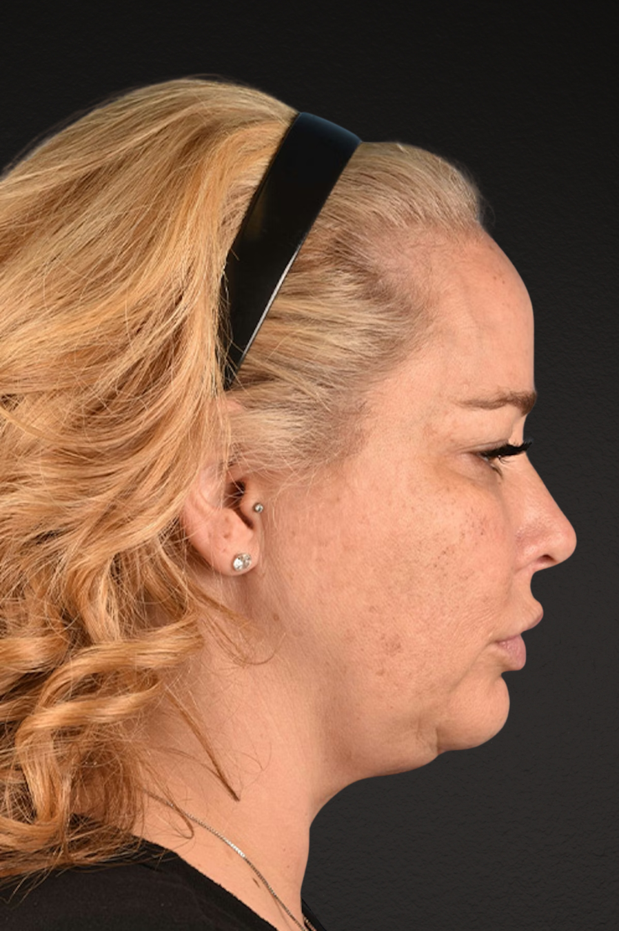 Renuvion Before & After Gallery - Patient 364740 - Image 7