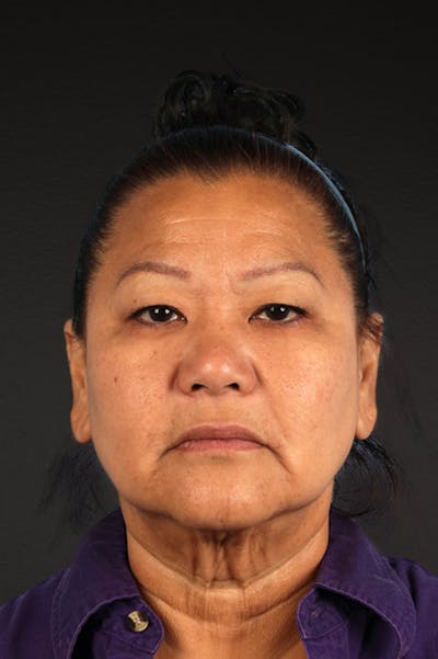 Renuvion Before & After Gallery - Patient 125918 - Image 1