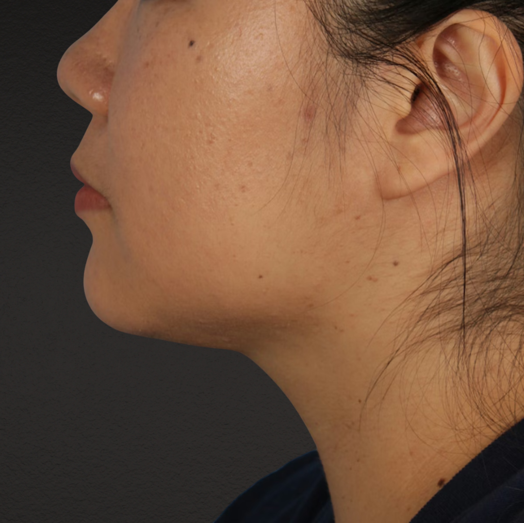 Renuvion Before & After Gallery - Patient 296884 - Image 2