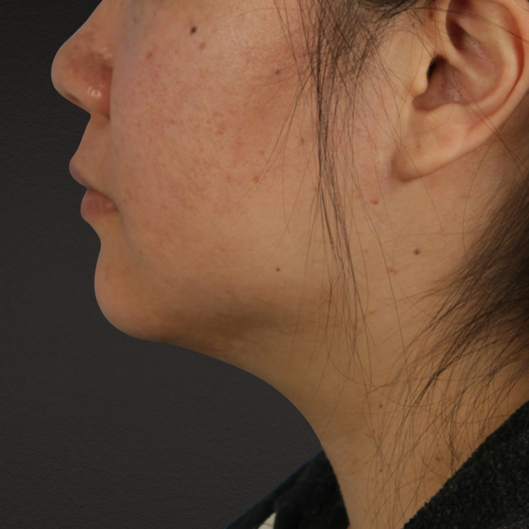 Renuvion Before & After Gallery - Patient 296884 - Image 1