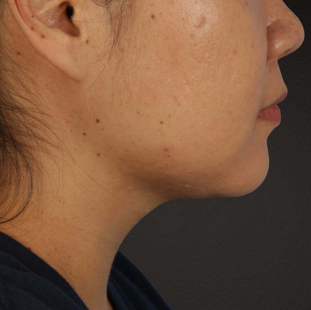 Renuvion Before & After Gallery - Patient 296884 - Image 4