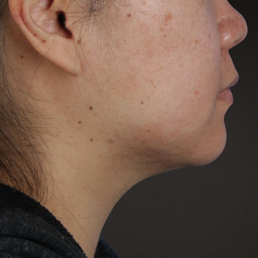 Renuvion Before & After Gallery - Patient 296884 - Image 3
