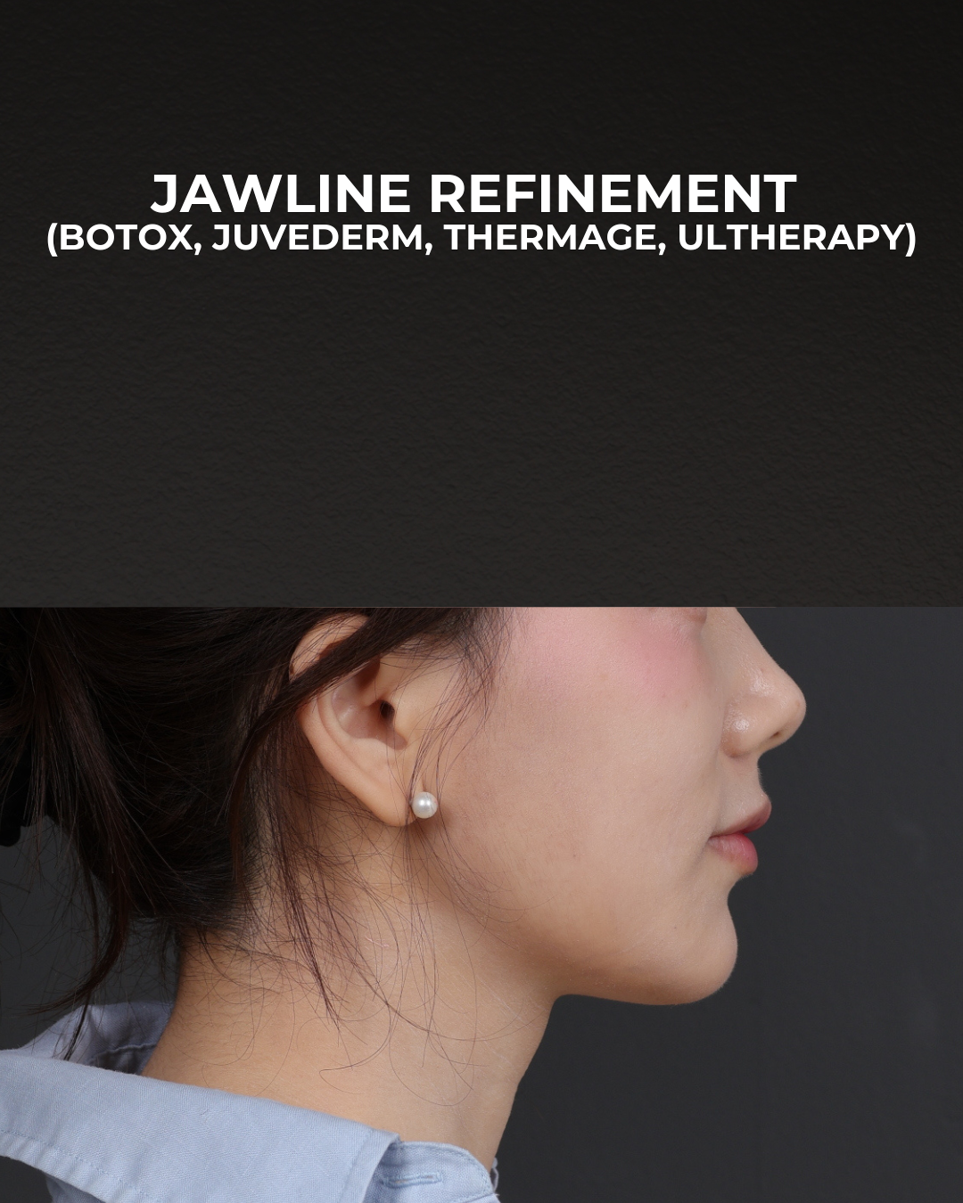 Thermage FLX  Before & After Gallery - Patient 265507 - Image 4