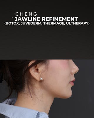 Thermage FLX Before & After Gallery - Patient 265507 - Image 4