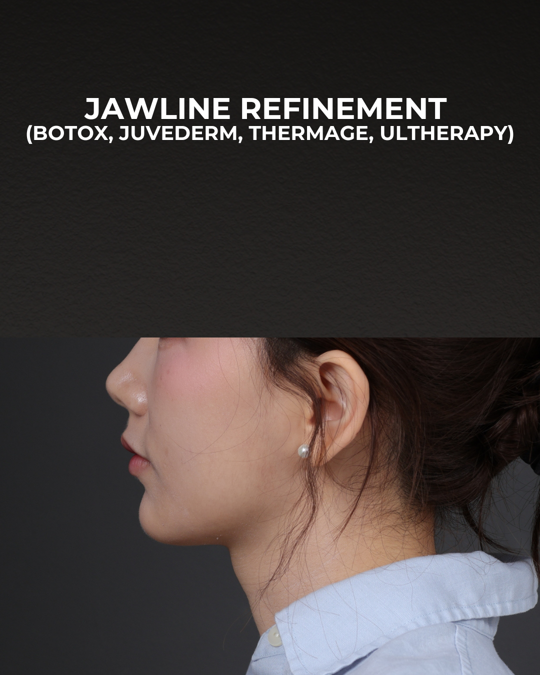 Thermage FLX  Before & After Gallery - Patient 265507 - Image 8