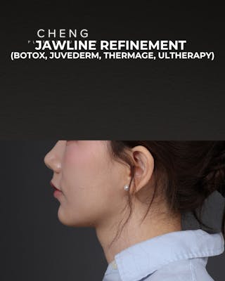 Thermage FLX Before & After Gallery - Patient 265507 - Image 8