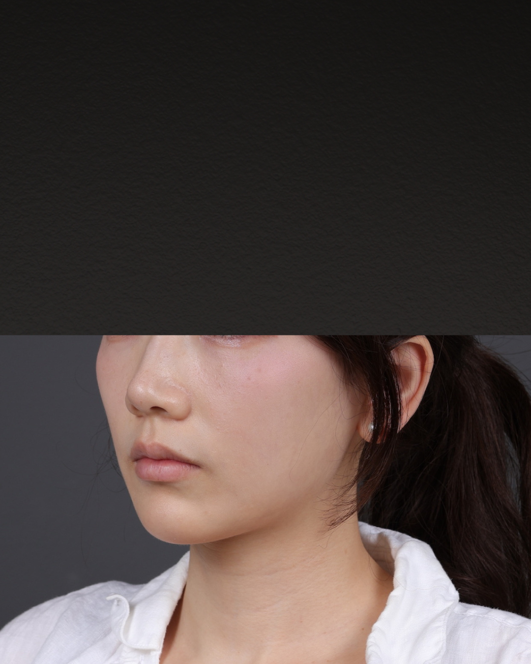 Thermage FLX  Before & After Gallery - Patient 265507 - Image 5