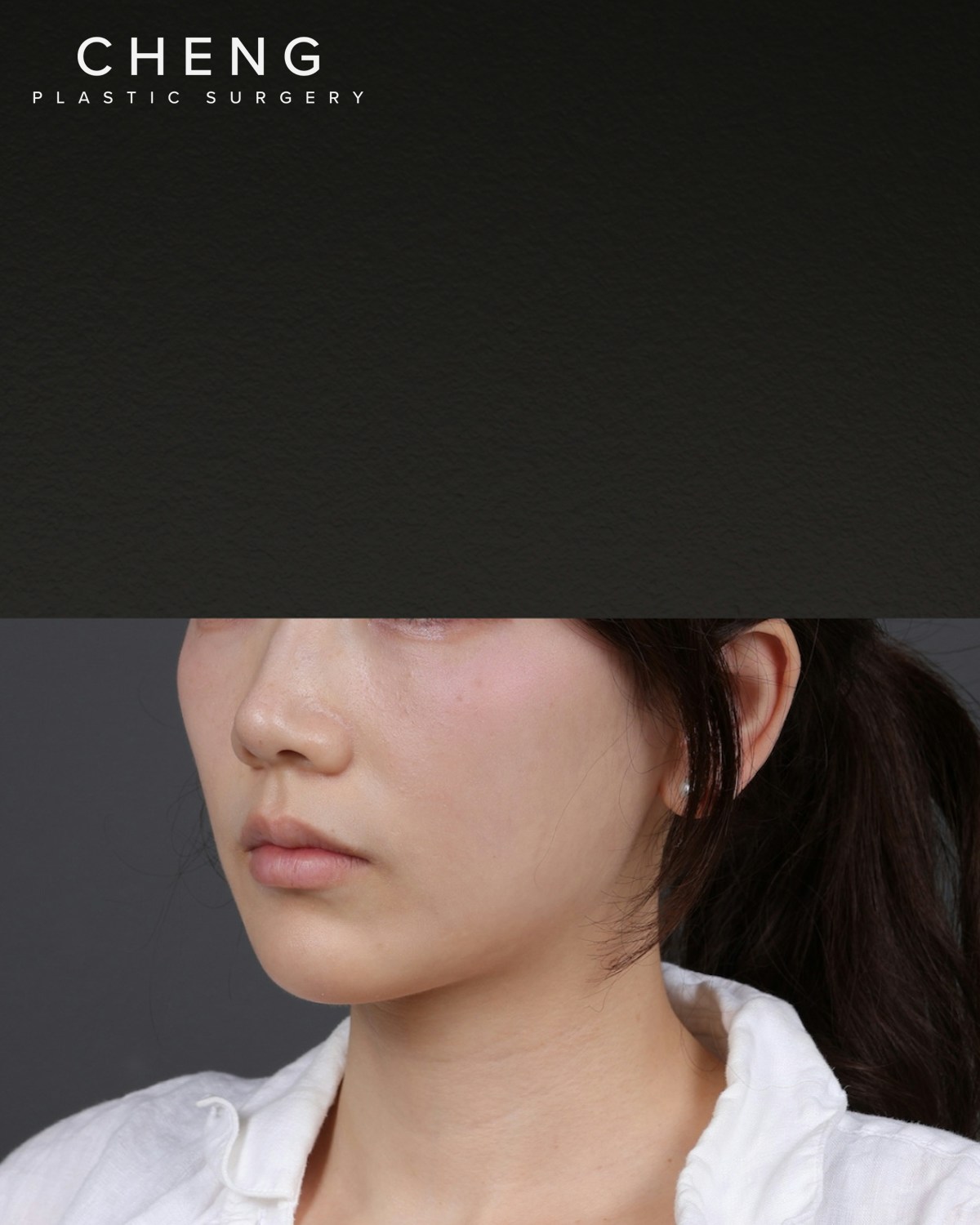 Thermage FLX Before & After Gallery - Patient 265507 - Image 5