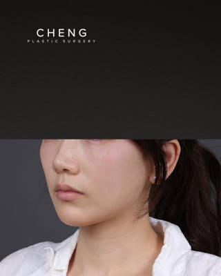 Thermage FLX Before & After Gallery - Patient 265507 - Image 5