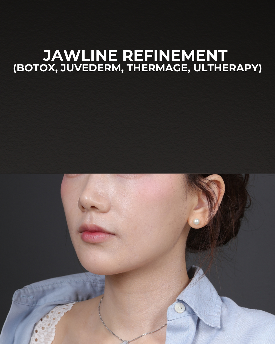 Thermage FLX  Before & After Gallery - Patient 265507 - Image 6