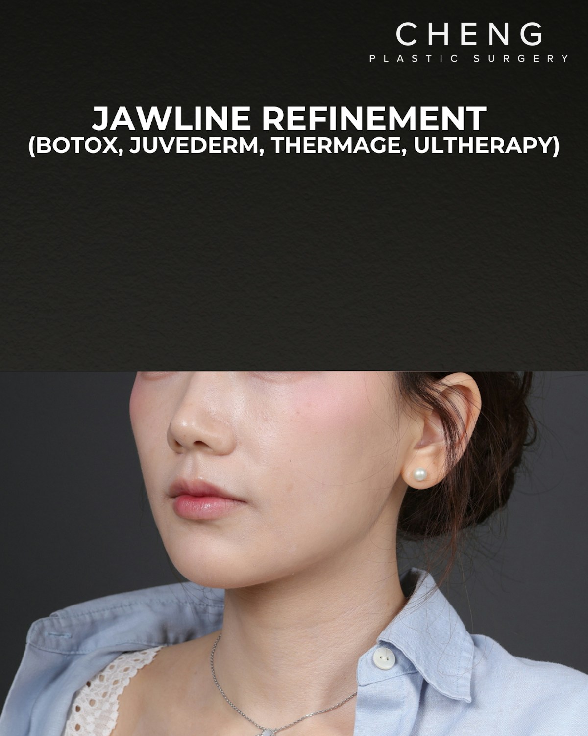Thermage FLX Before & After Gallery - Patient 265507 - Image 6