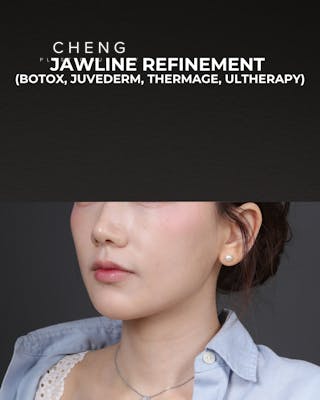 Thermage FLX Before & After Gallery - Patient 265507 - Image 6