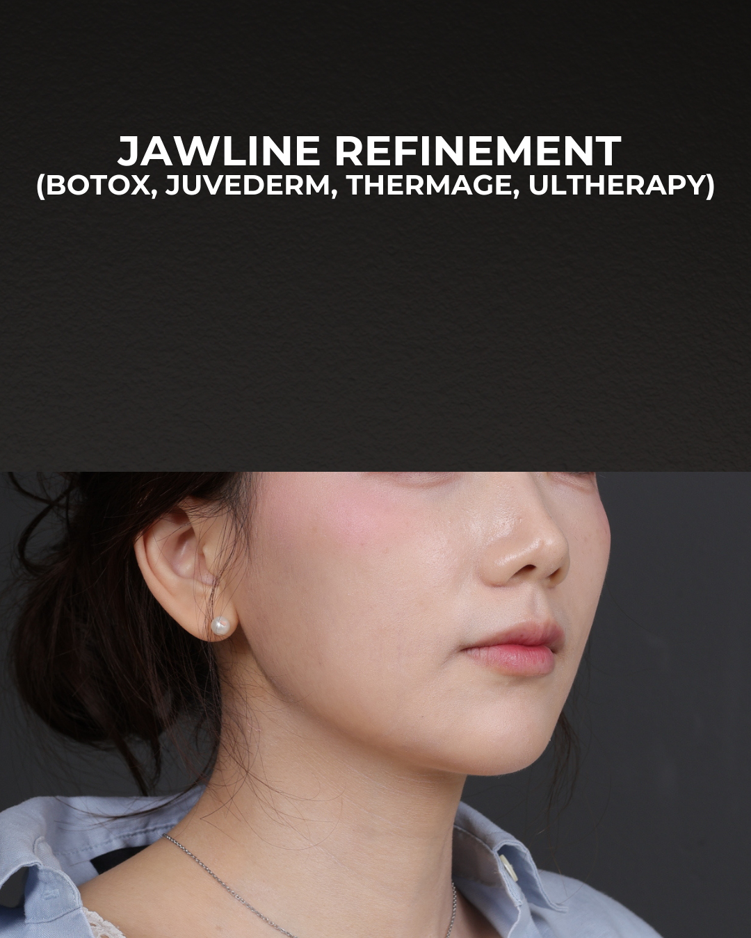 Thermage FLX  Before & After Gallery - Patient 265507 - Image 2