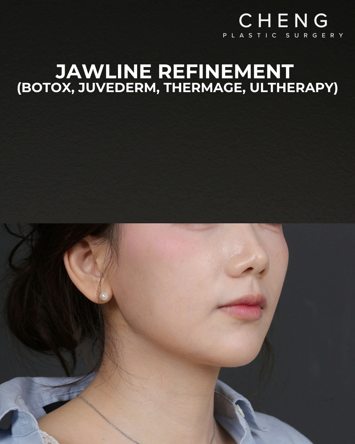 Thermage FLX Before & After Gallery - Patient 265507 - Image 2