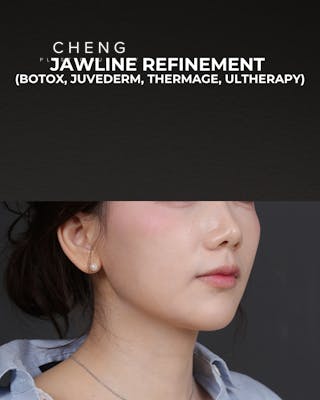 Thermage FLX Before & After Gallery - Patient 265507 - Image 2