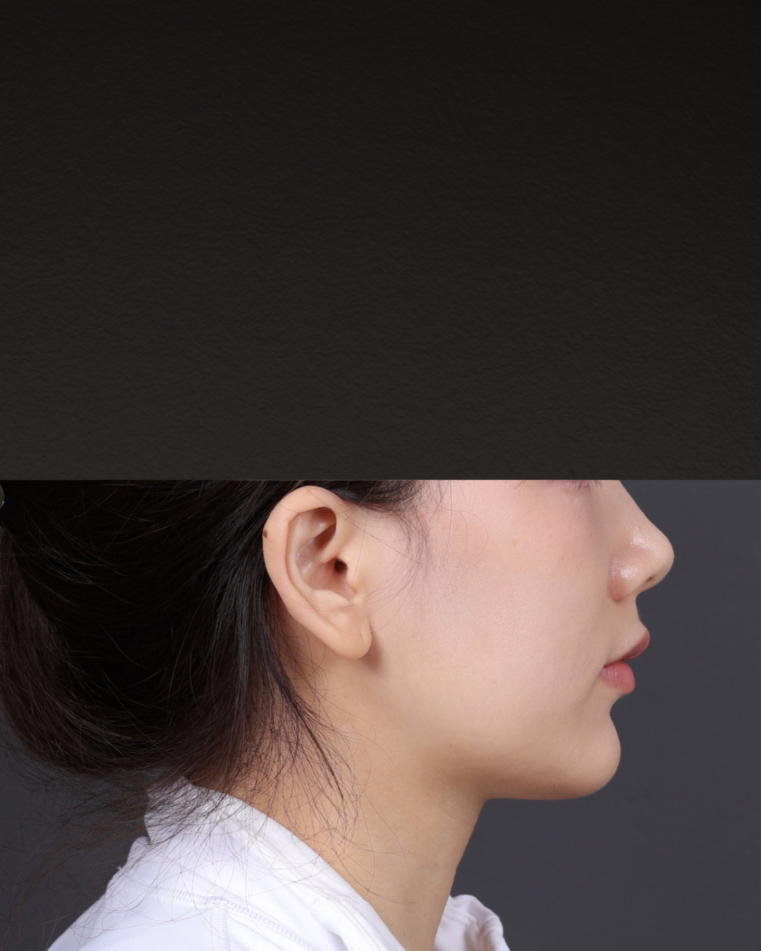 Thermage FLX  Before & After Gallery - Patient 265507 - Image 3