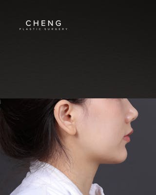 Thermage FLX Before & After Gallery - Patient 265507 - Image 3