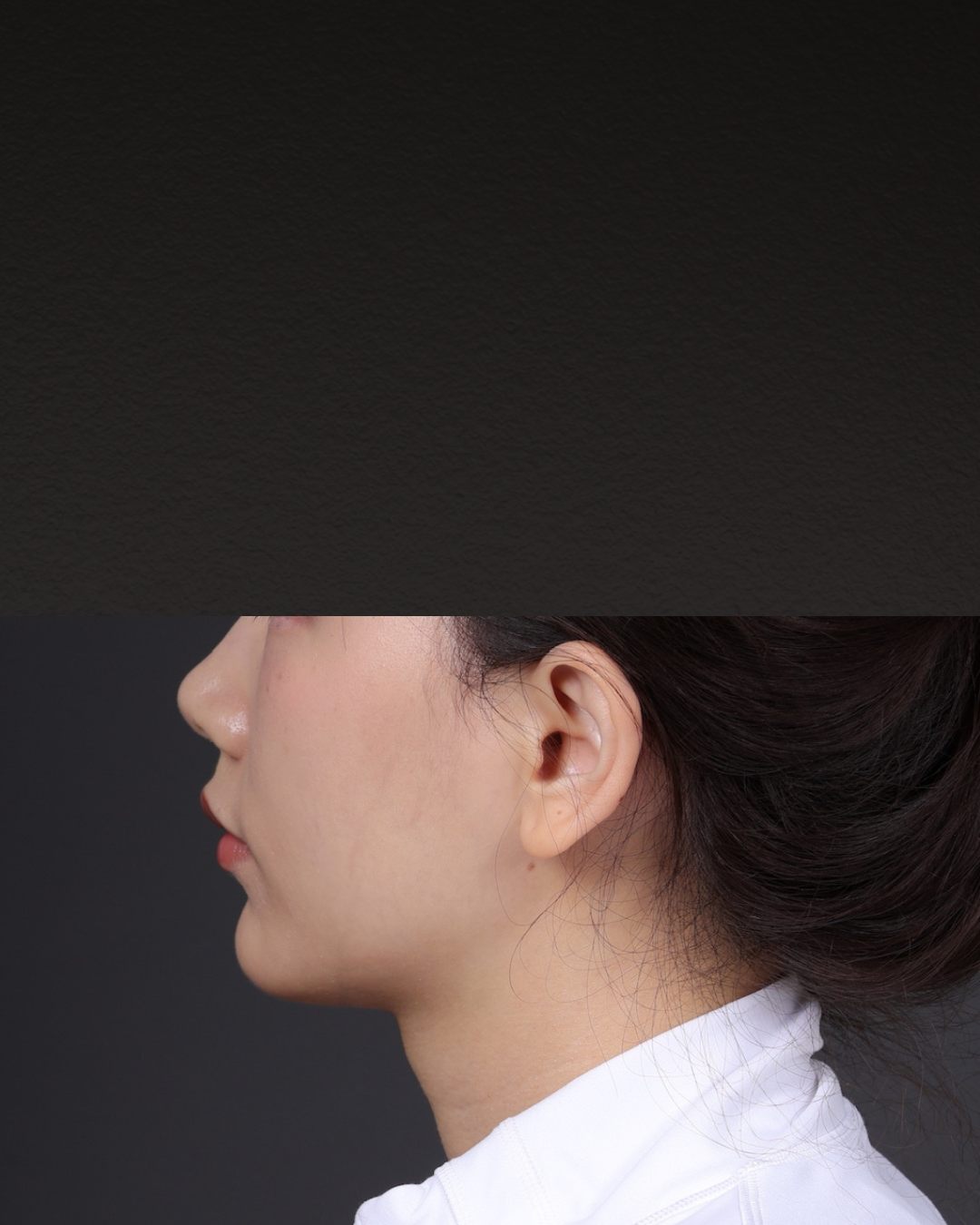 Thermage FLX  Before & After Gallery - Patient 265507 - Image 7