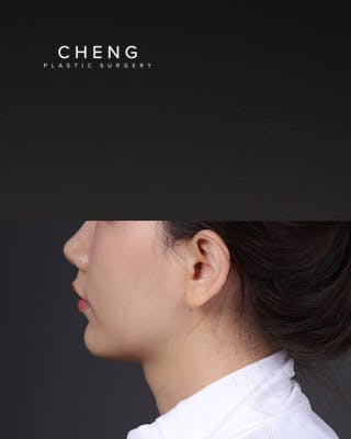 Thermage FLX Before & After Gallery - Patient 265507 - Image 7