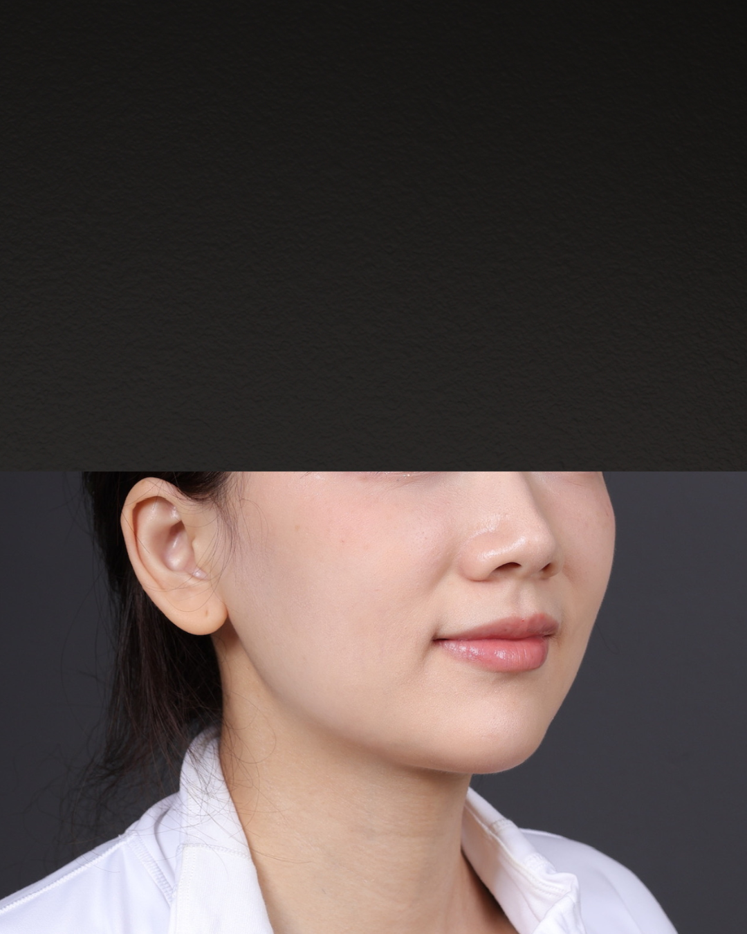 Thermage FLX  Before & After Gallery - Patient 265507 - Image 1
