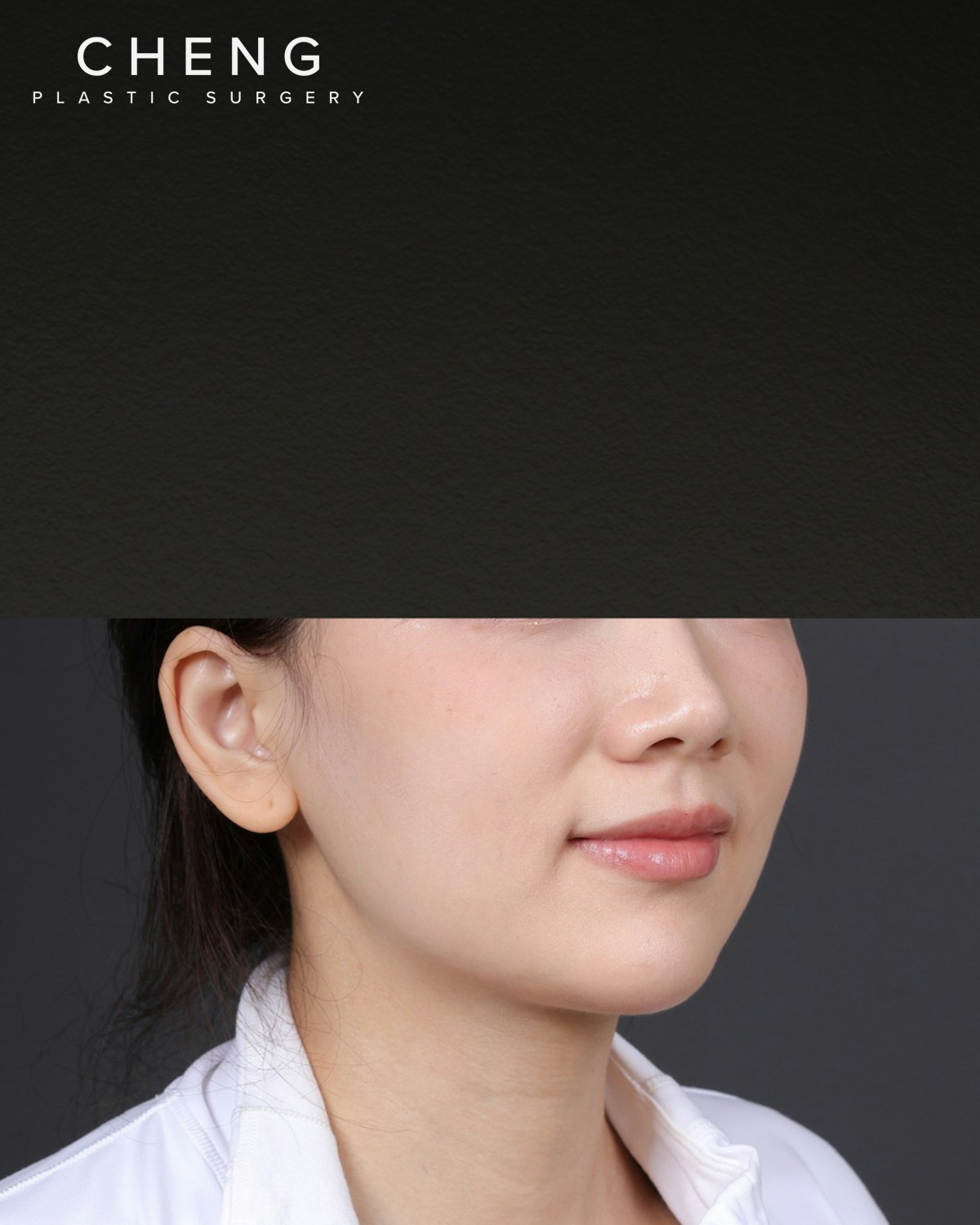 Thermage FLX Before & After Gallery - Patient 265507 - Image 1