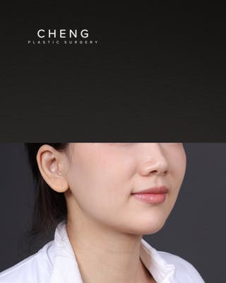 Thermage FLX Before & After Gallery - Patient 265507 - Image 1