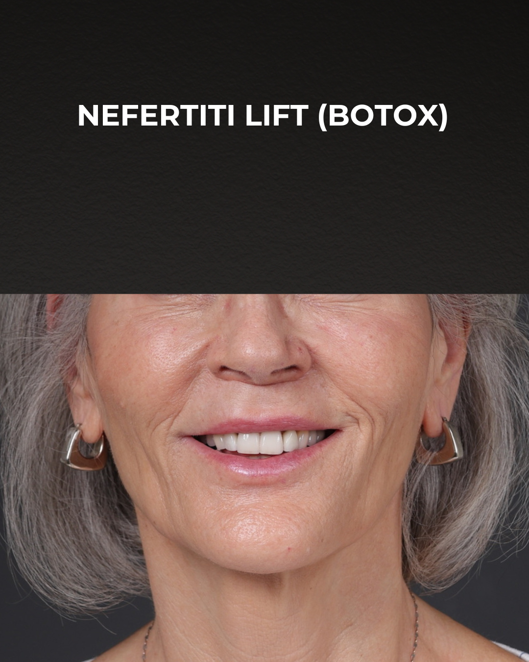 Botox and Dysport Before & After Gallery - Patient 543799 - Image 2