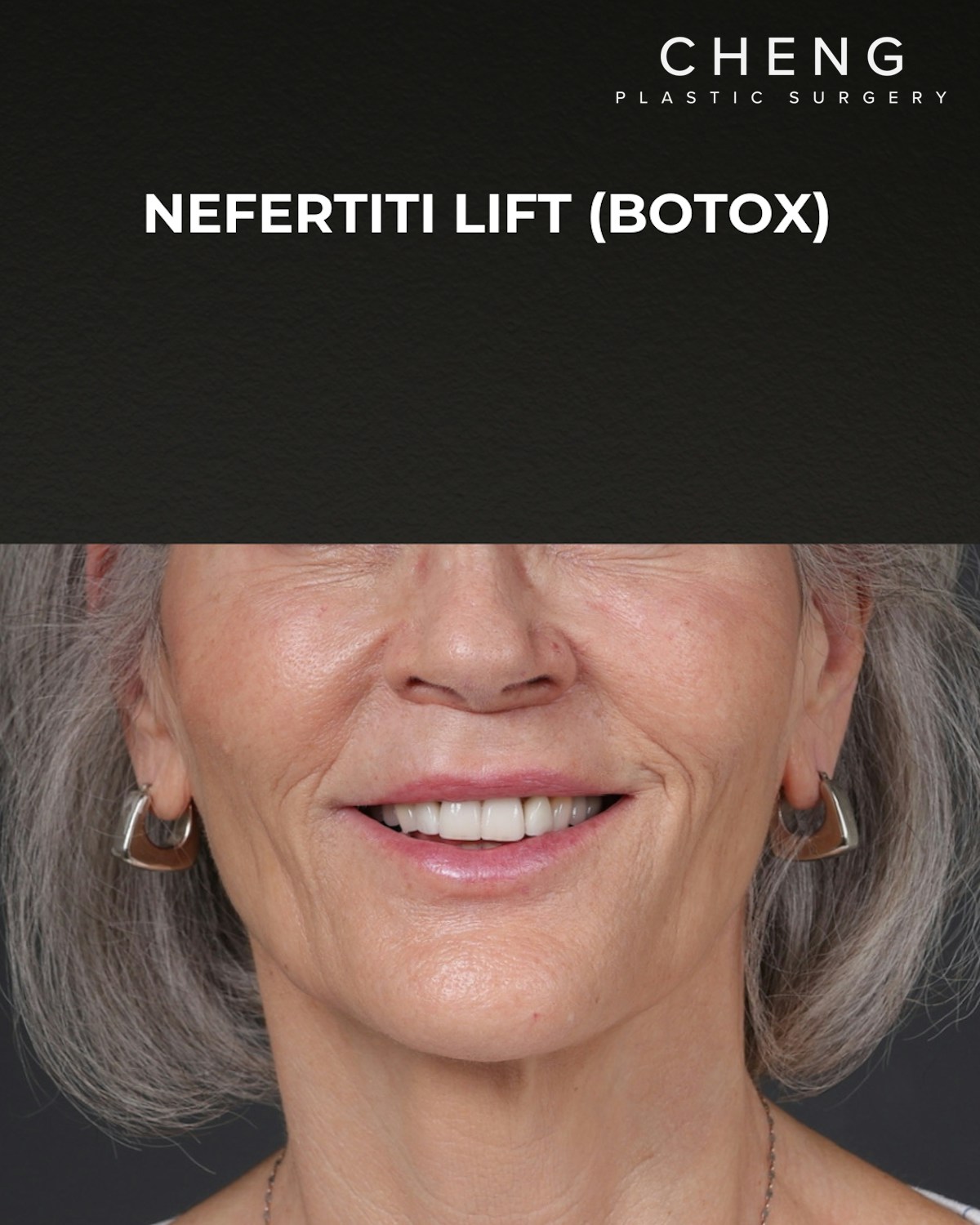 Botox and Dysport Before & After Gallery - Patient 543799 - Image 2