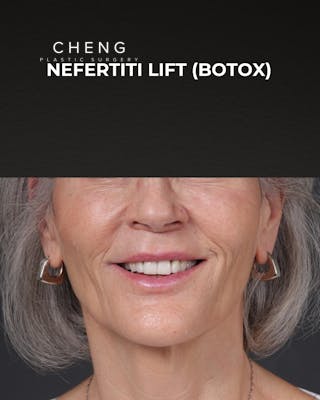 Botox and Dysport Before & After Gallery - Patient 543799 - Image 2