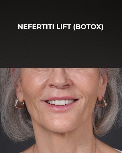 Botox and Dysport Before & After Gallery - Patient 543799 - Image 2