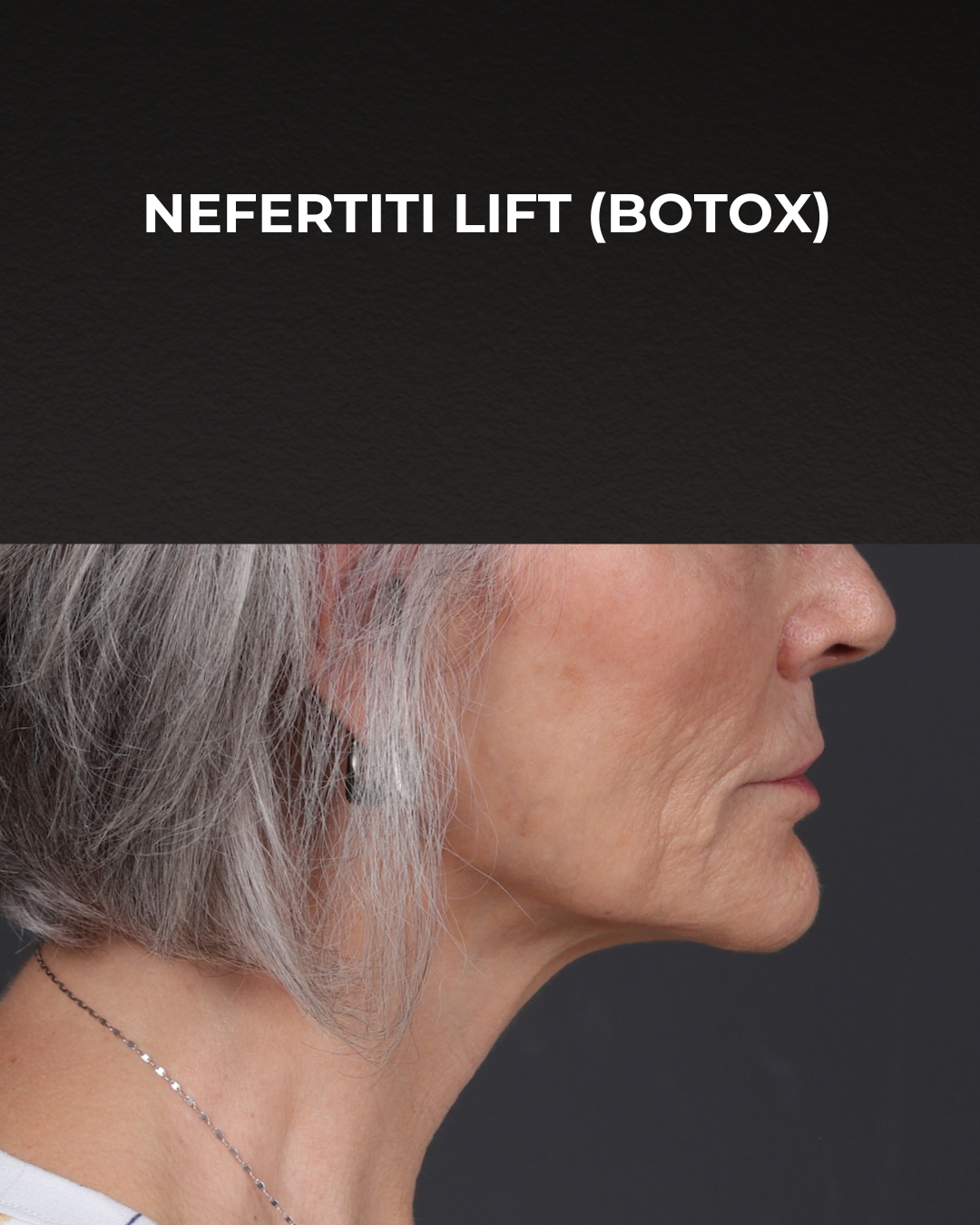 Botox and Dysport Before & After Gallery - Patient 543799 - Image 4