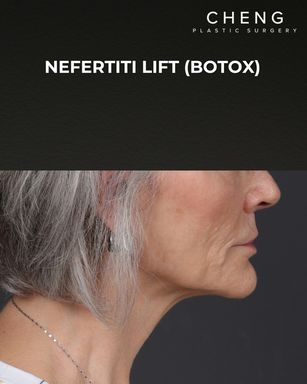 Botox and Dysport Before & After Gallery - Patient 543799 - Image 4