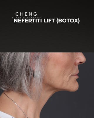 Botox and Dysport Before & After Gallery - Patient 543799 - Image 4