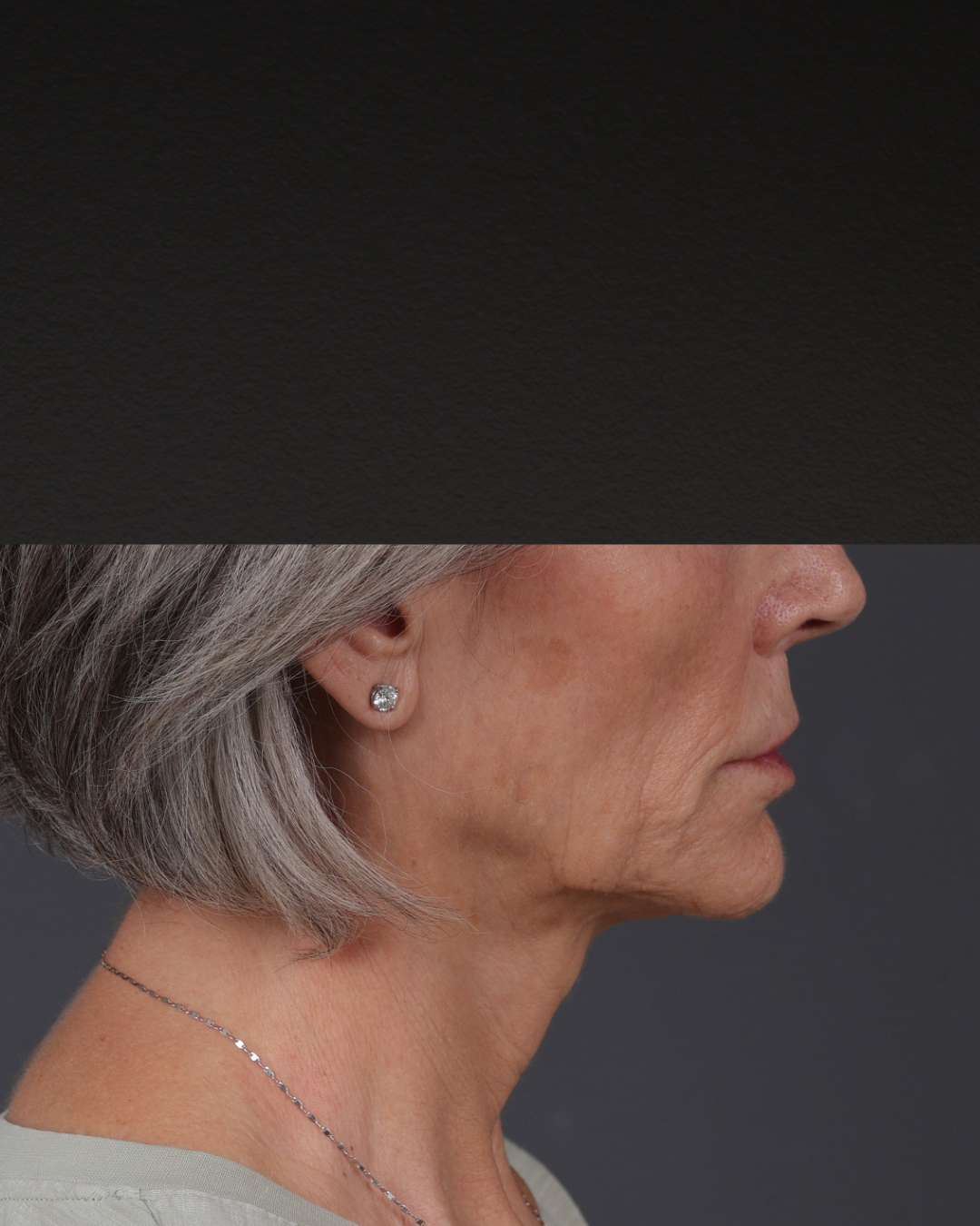 Botox and Dysport Before & After Gallery - Patient 543799 - Image 3