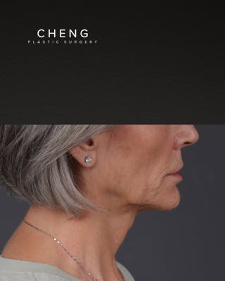 Botox and Dysport Before & After Gallery - Patient 543799 - Image 3