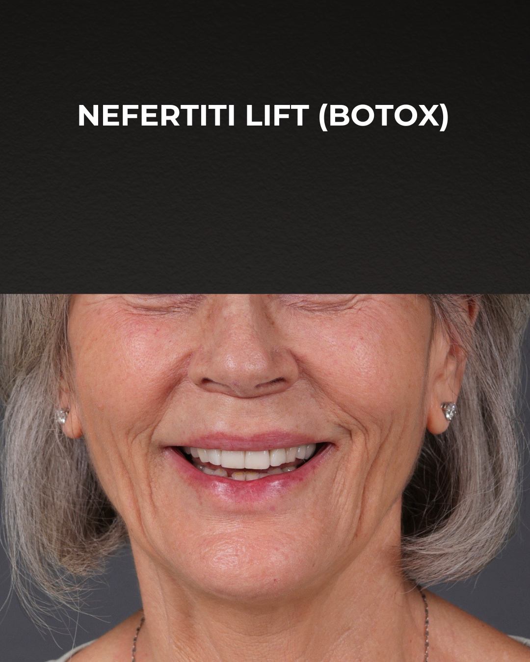 Botox and Dysport Before & After Gallery - Patient 543799 - Image 1
