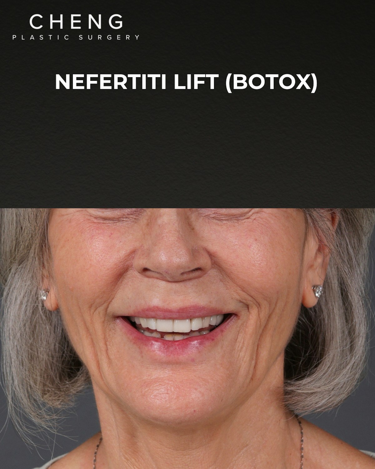 Botox and Dysport Before & After Gallery - Patient 543799 - Image 1