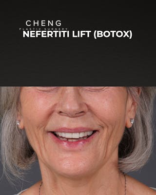 Botox and Dysport Before & After Gallery - Patient 543799 - Image 1