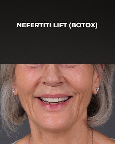 Botox and Dysport Before & After Gallery - Patient 543799 - Image 1