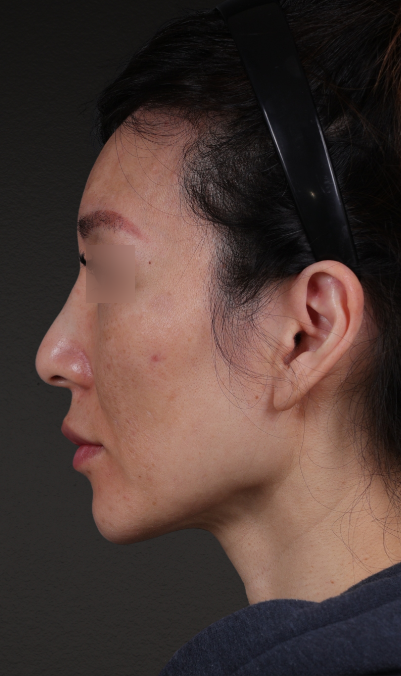 Fat Grafting Before & After Gallery - Patient 320694 - Image 9